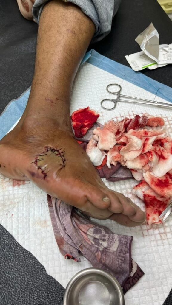 Sutured foot wound after minor surgery at clinic near Taman Lestari Putra, Seri Kembangan